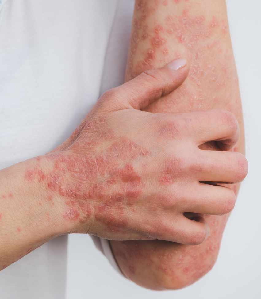 M-Eczema Capsule & Cream – healthy lifestyle