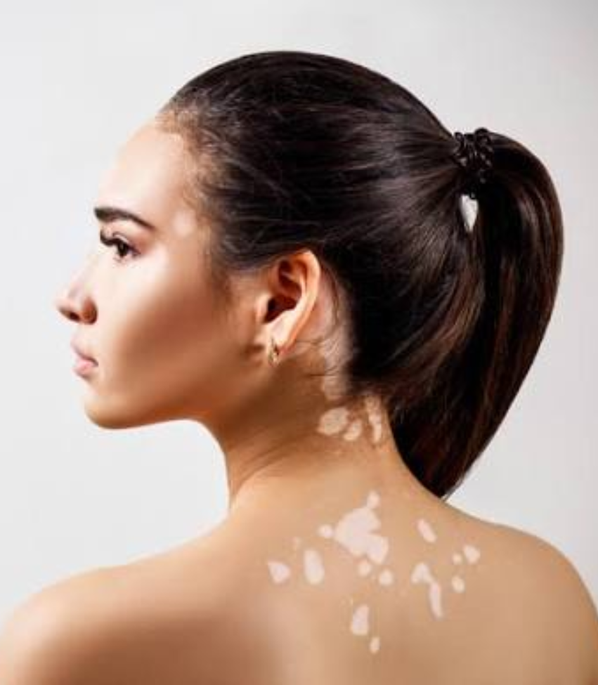 Swetvitil Care Capsule & Cream – healthy lifestyle
